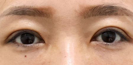 After double eyelid surgery and ptosis correction