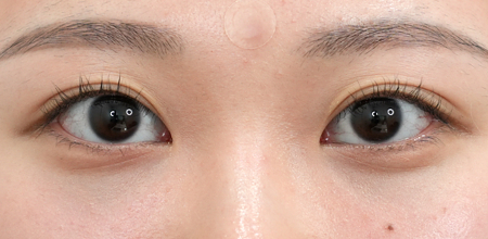 under-eye fat repositioning case 2 after
