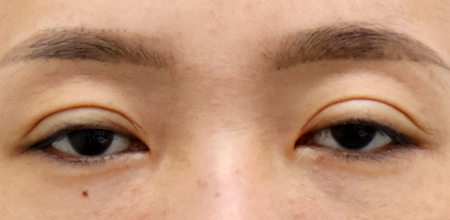 Before double eyelid surgery and ptosis correction