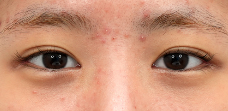Medial epicanthoplasty case 1 after surgery