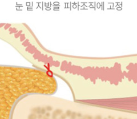 눈밑지방재배치 일반 내부 고정 방식
