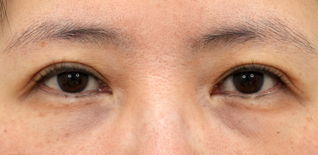 under-eye fat repositioning case 3 before
