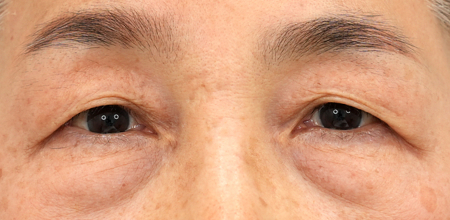 Upper eyelid surgery before