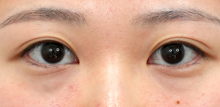 under-eye fat repositioning case 2 before