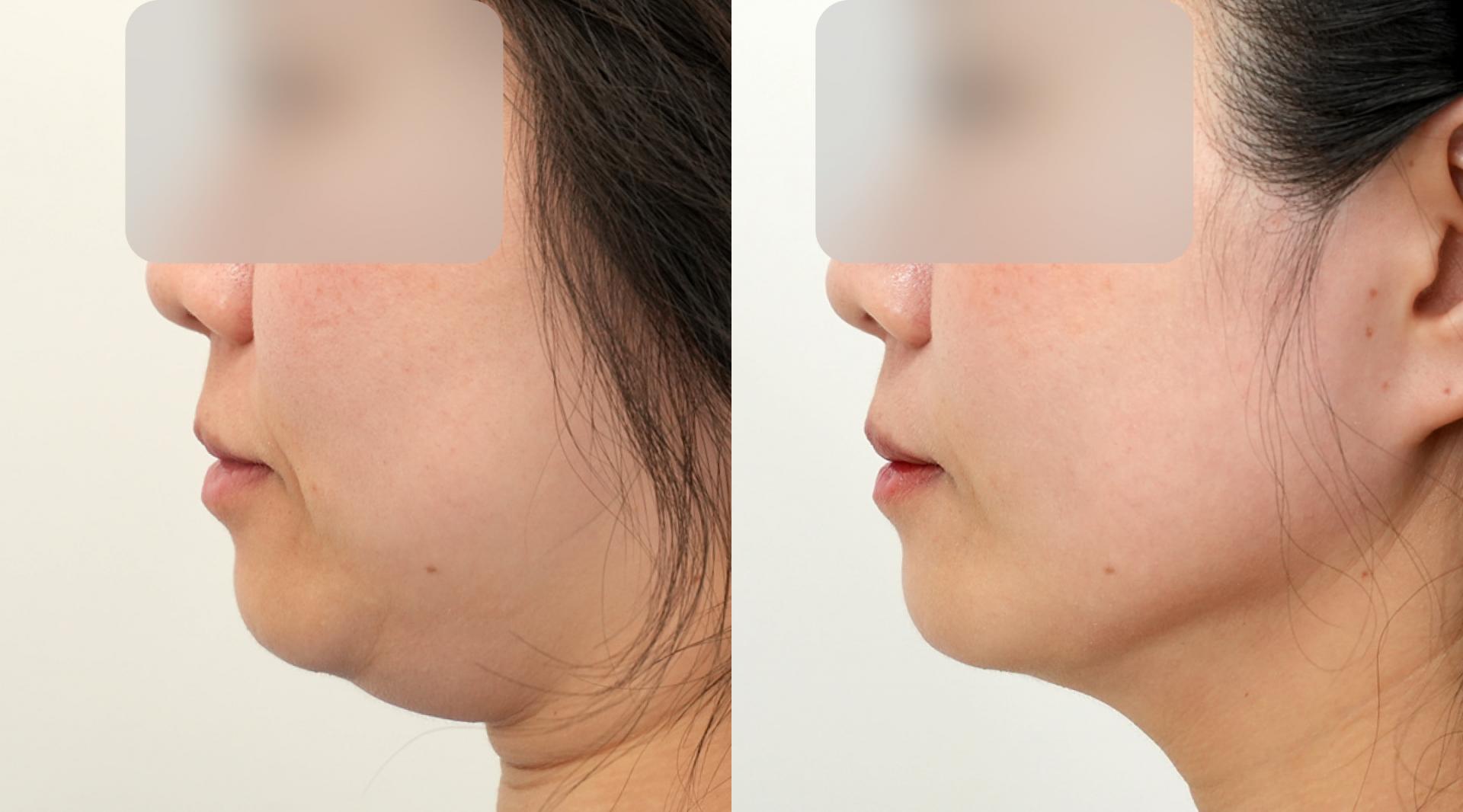 Double chin liposuction and thread lifting before and after — example 2, IK Plastic Surgery
