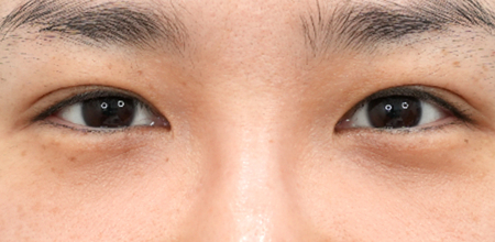 under-eye fat repositioning case 1 after