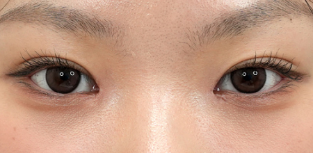 After non-incisional double eyelid surgery