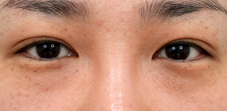 under-eye fat repositioning case 1 before
