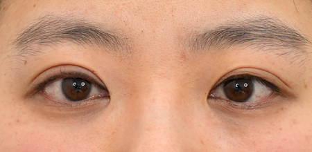 Medial epicanthoplasty case 5 before surgery