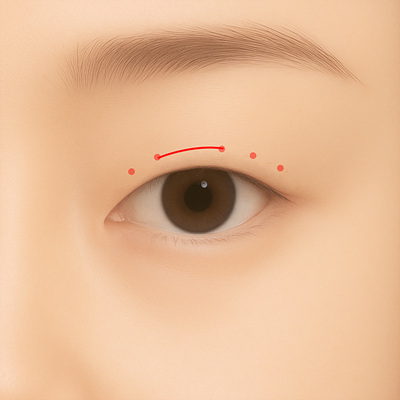 Partial-incision double eyelid surgery illustration