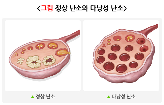 다낭성난소증후군 좋아질 수 있어요!