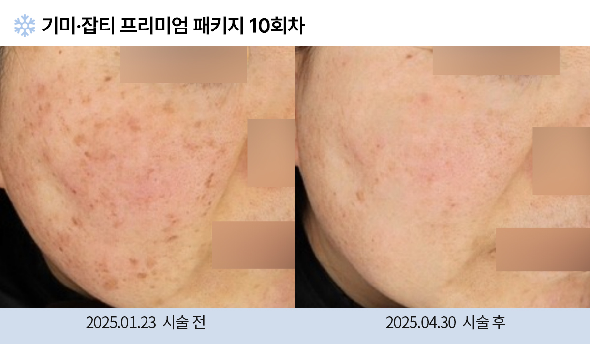 기미/주근깨/잡티 이미지