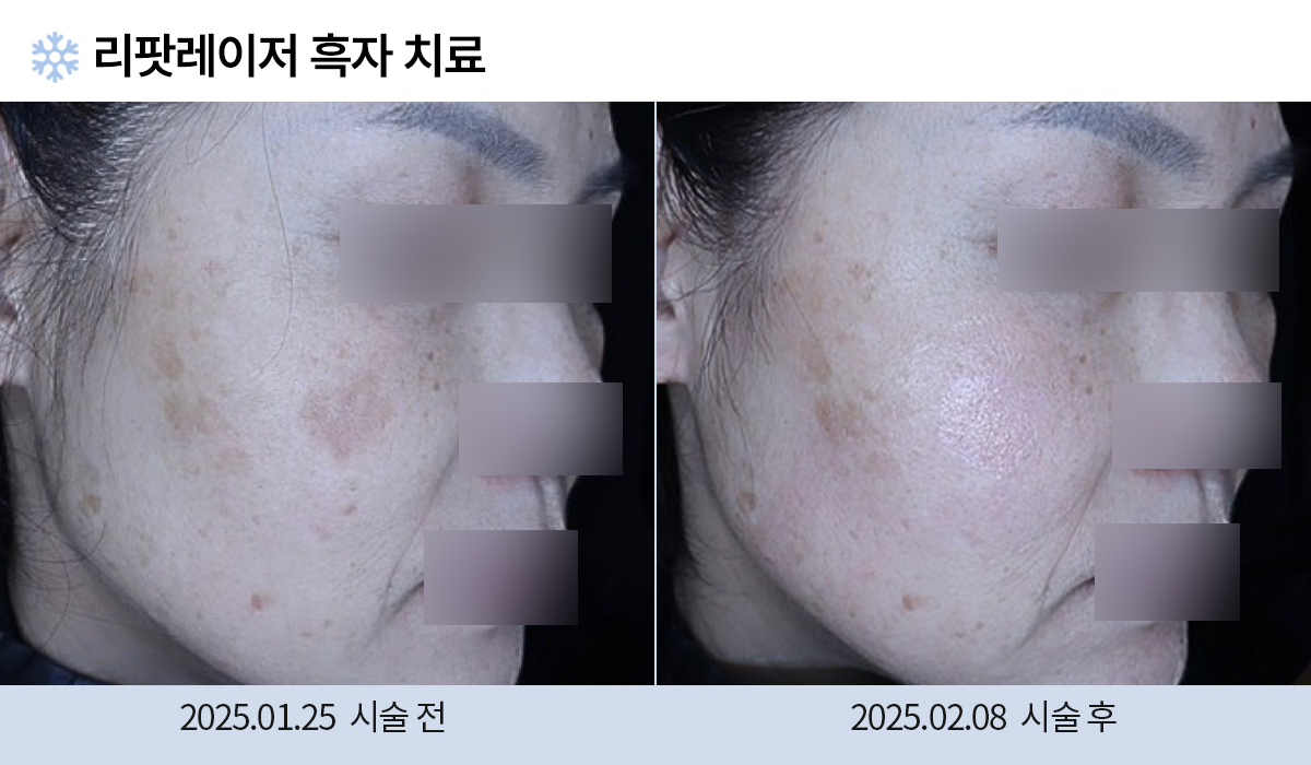 흑자/검버섯 이미지
