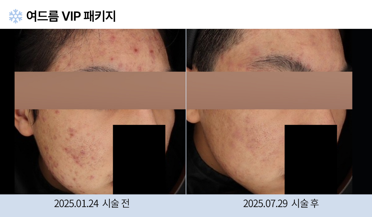 여드름/붉은자국/홍조 이미지