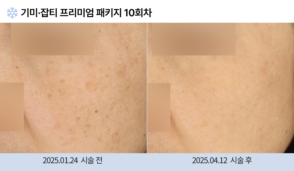 기미/주근깨/잡티 이미지