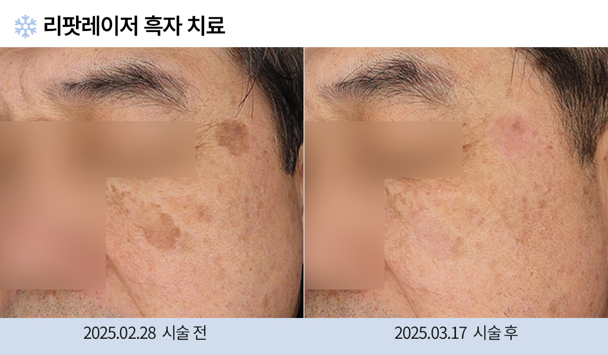 흑자/검버섯 이미지