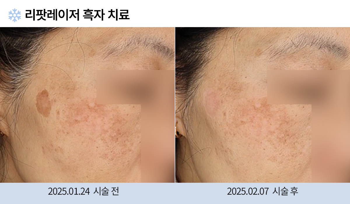 흑자/검버섯 이미지