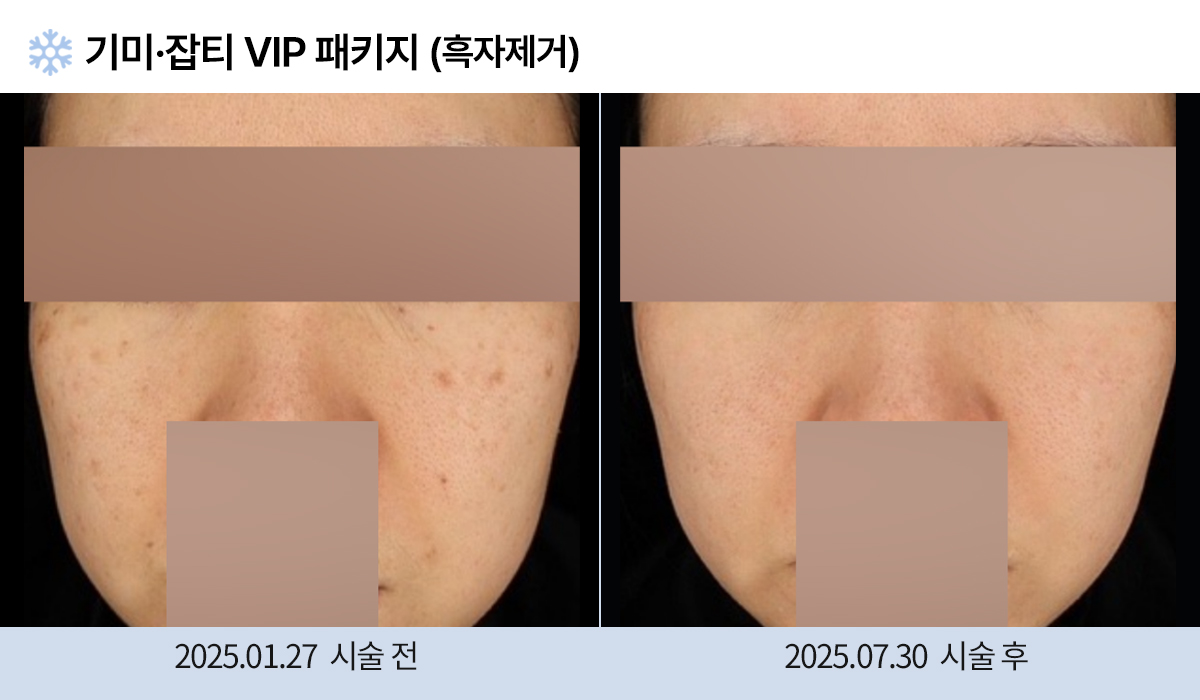 기미/주근깨/잡티 이미지