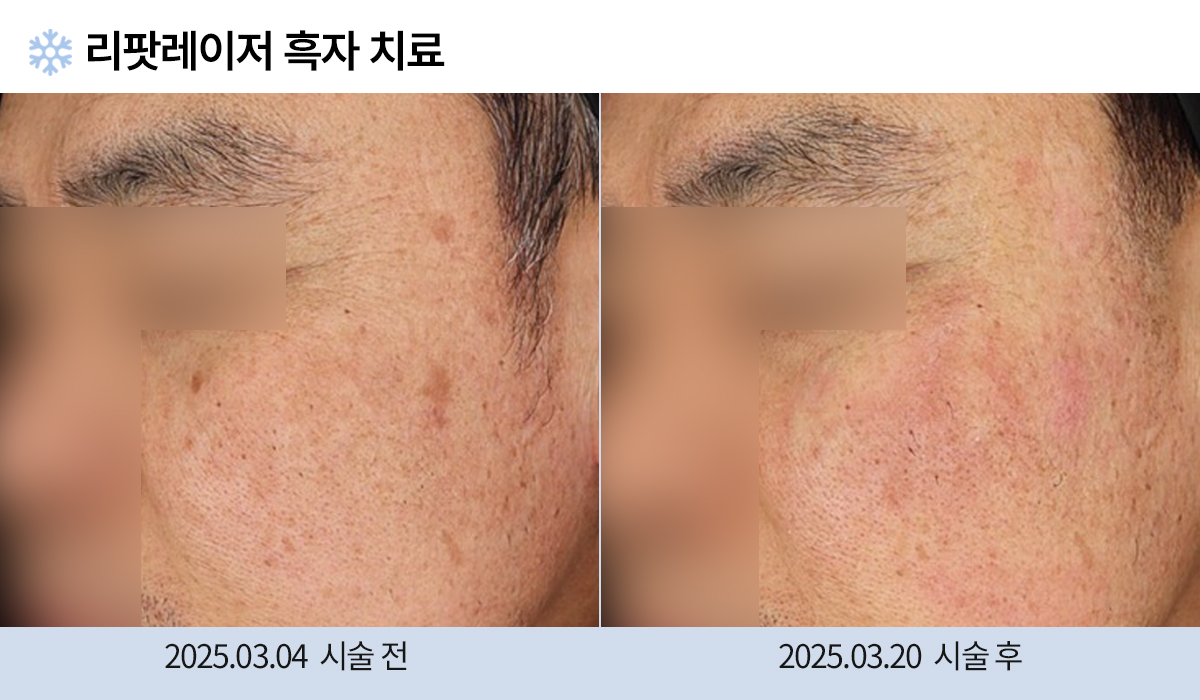 흑자/검버섯 이미지