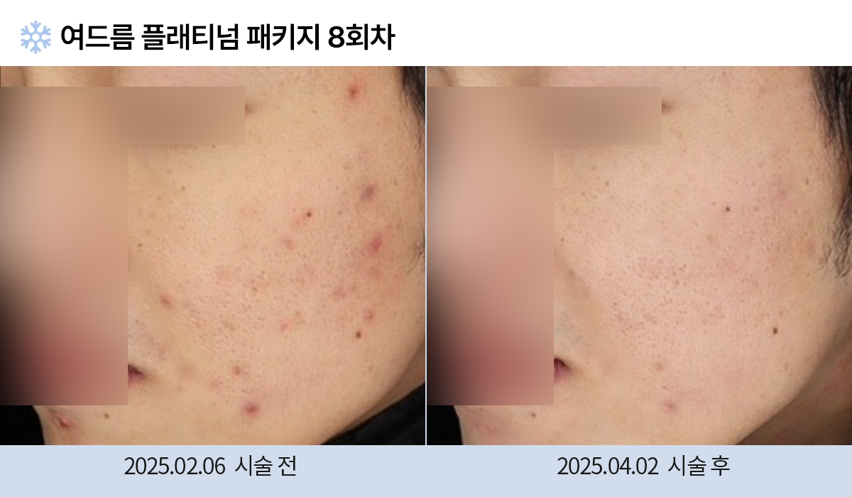 여드름/붉은자국/홍조 이미지