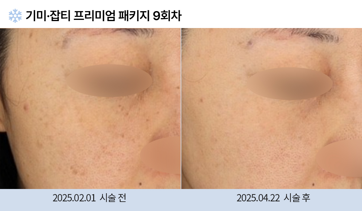 기미/주근깨/잡티 이미지
