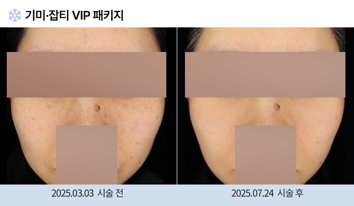 기미/주근깨/잡티 이미지