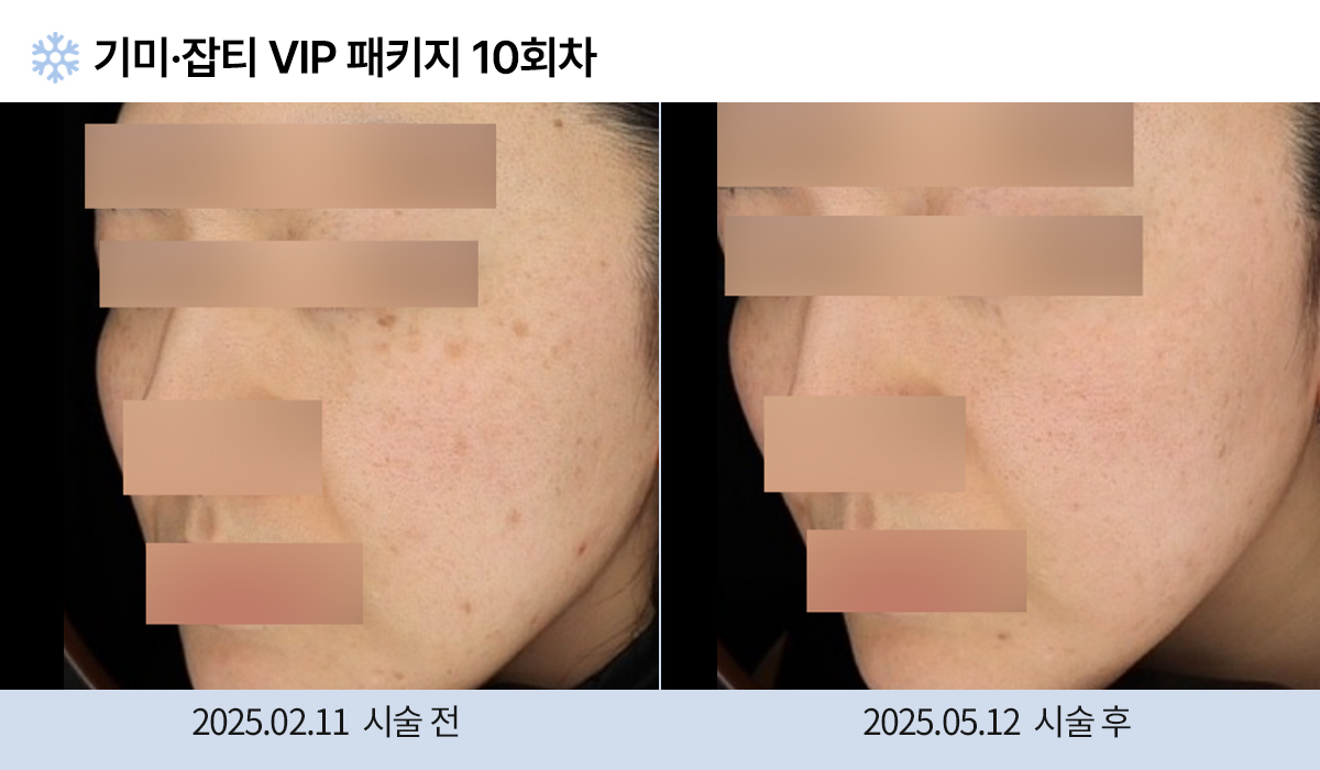 기미/주근깨/잡티 이미지