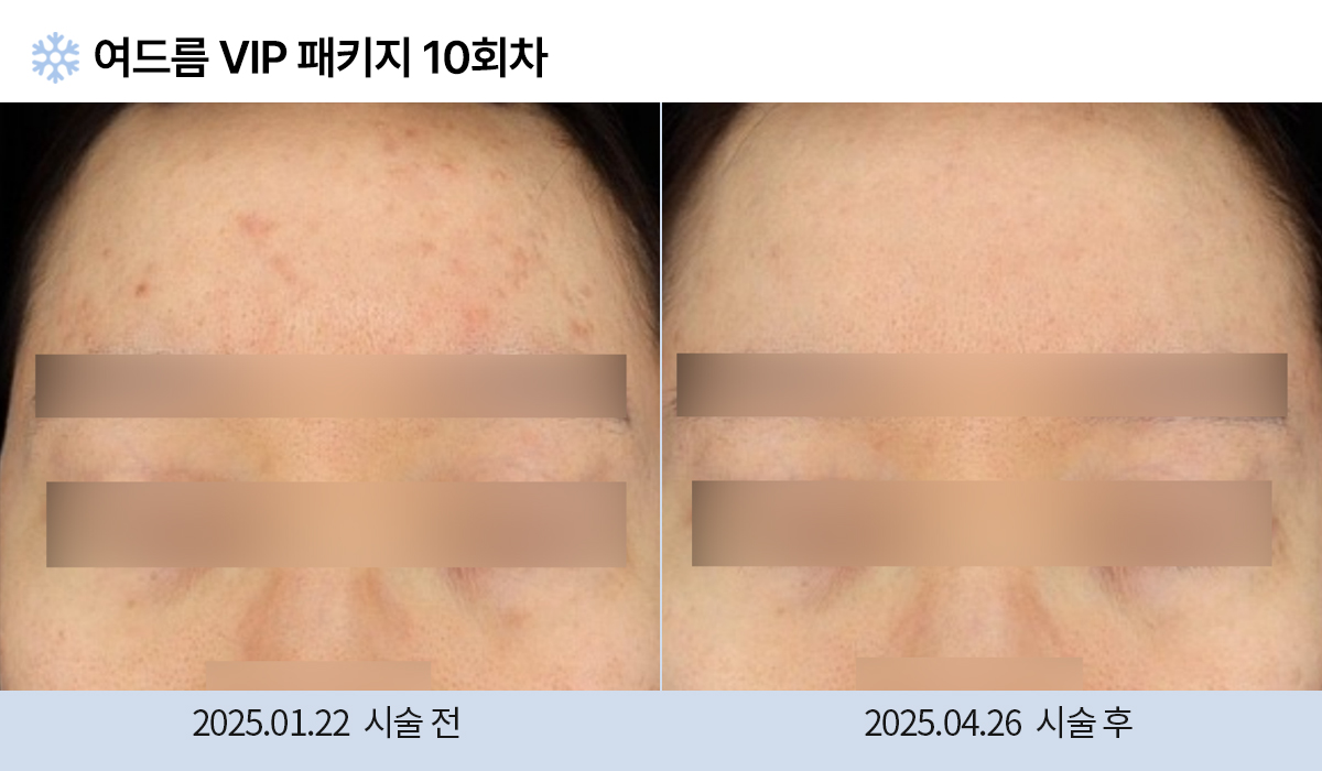 여드름/붉은자국/홍조 이미지