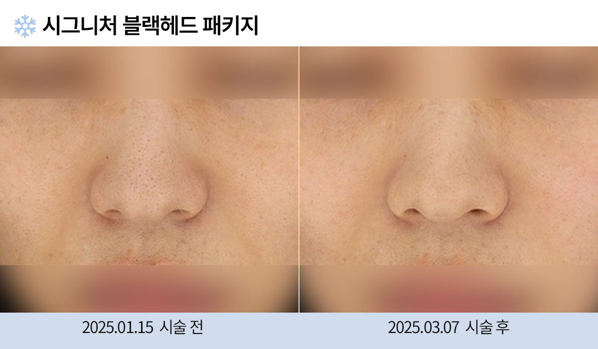 모공/흉터 이미지