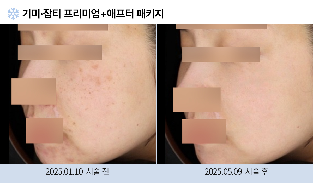 기미/주근깨/잡티 이미지
