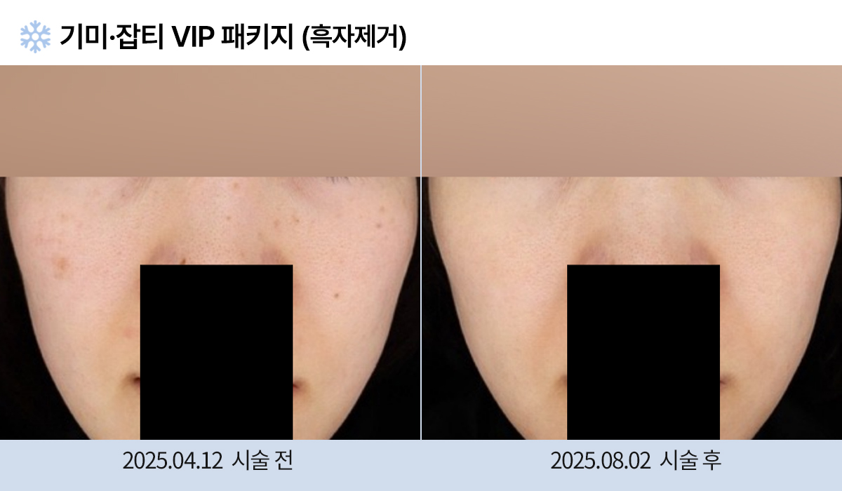 기미/주근깨/잡티 이미지