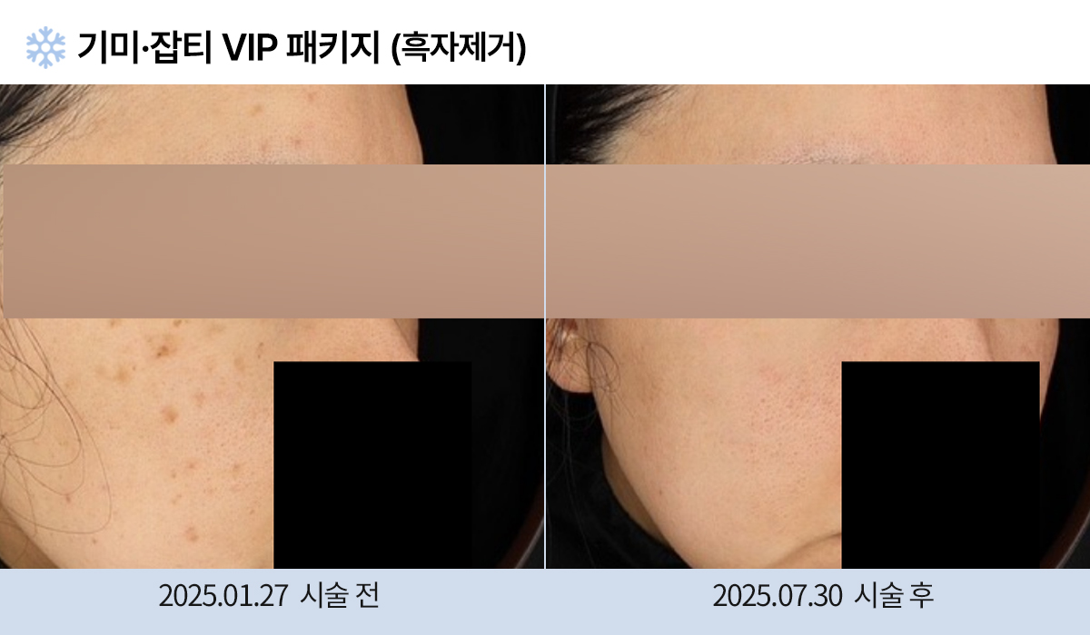 기미/주근깨/잡티 이미지