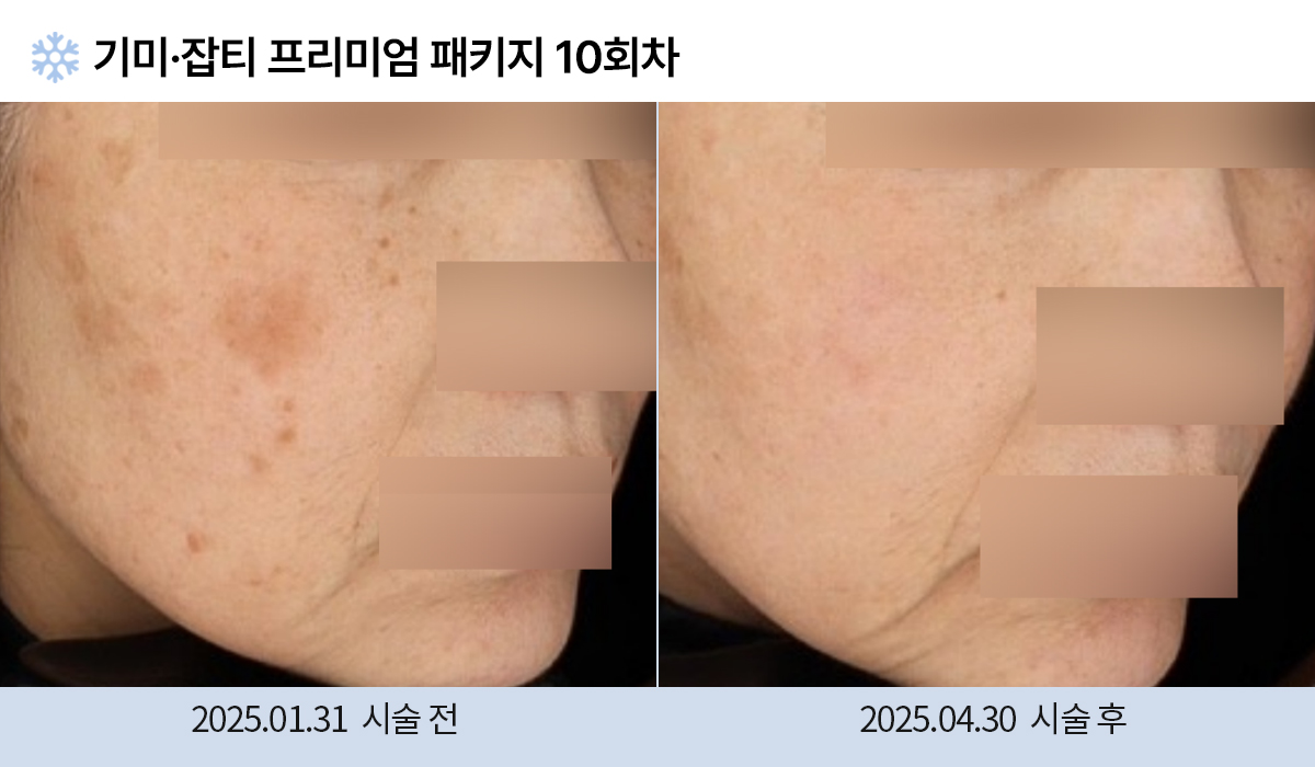 기미/주근깨/잡티 이미지