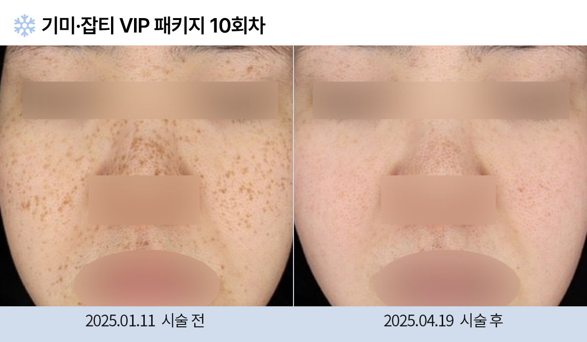 기미/주근깨/잡티 이미지