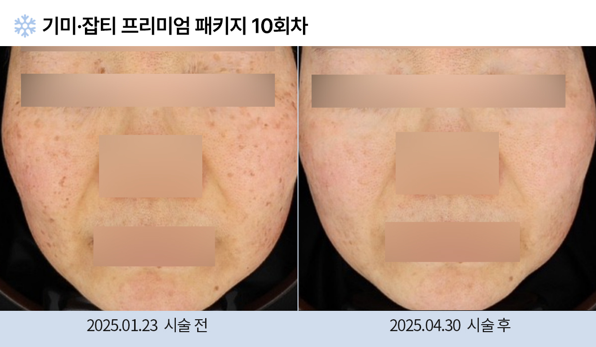 기미/주근깨/잡티 이미지