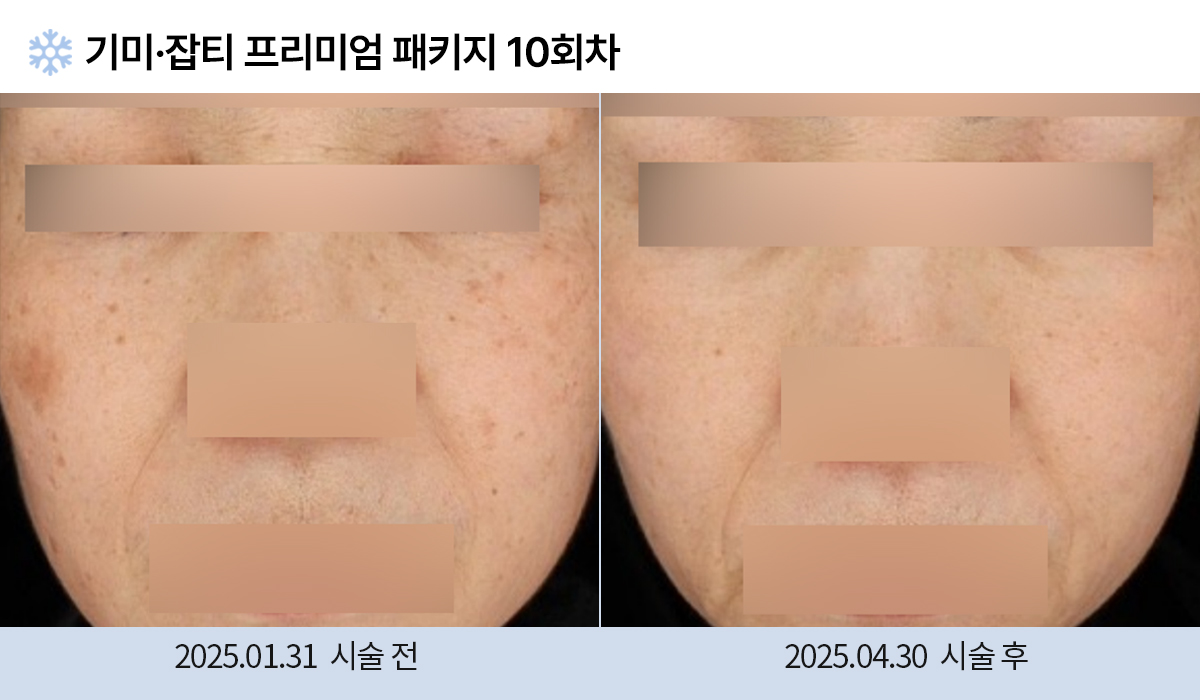 기미/주근깨/잡티 이미지