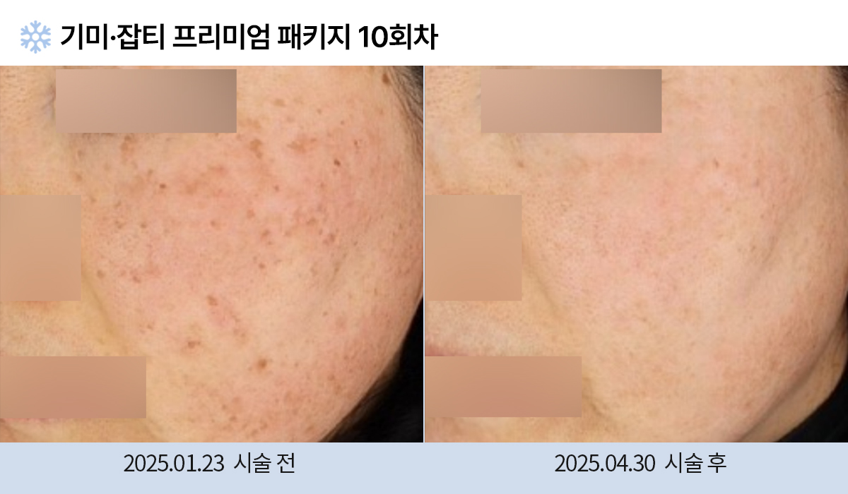 기미/주근깨/잡티 이미지