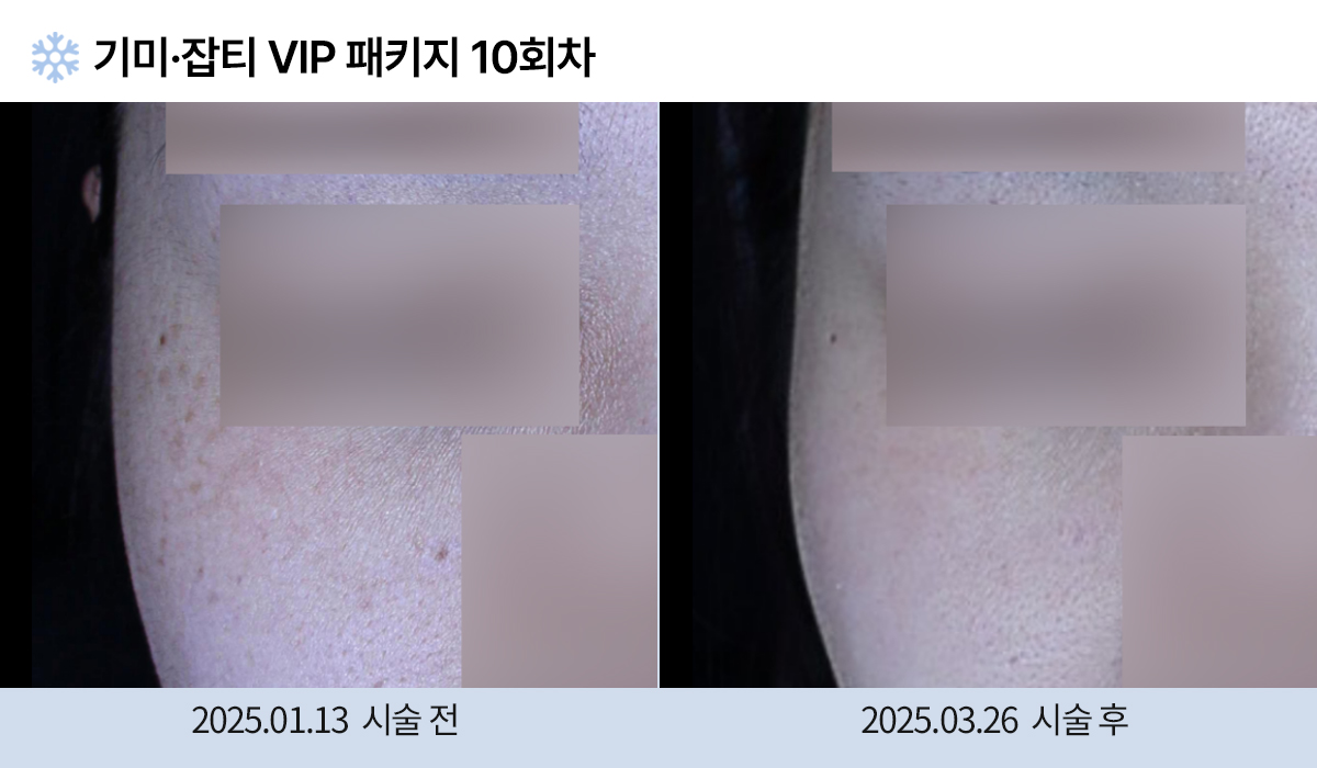 기미/주근깨/잡티 이미지