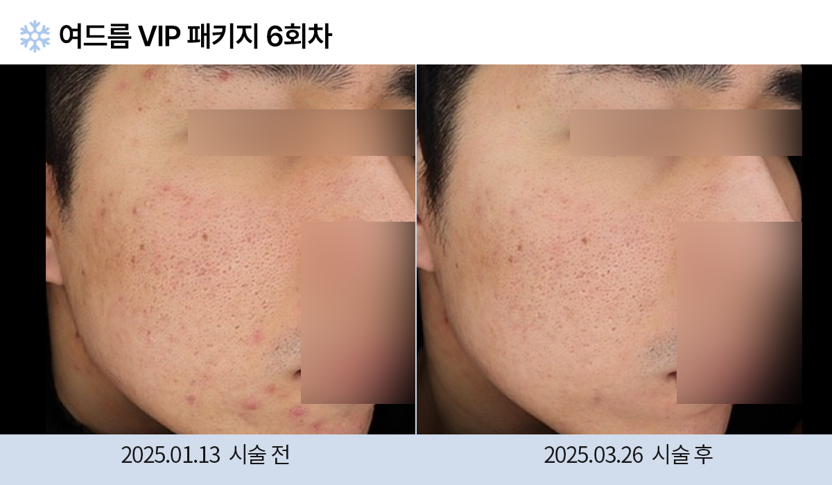 여드름/붉은자국/홍조 이미지
