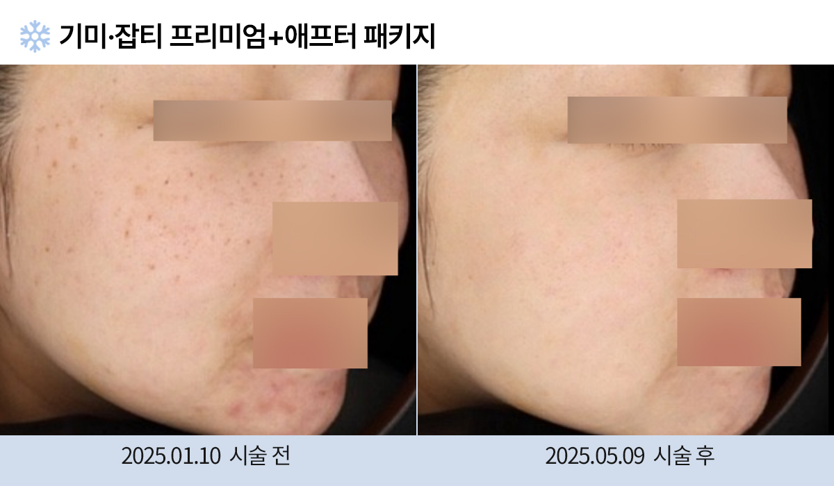 기미/주근깨/잡티 이미지
