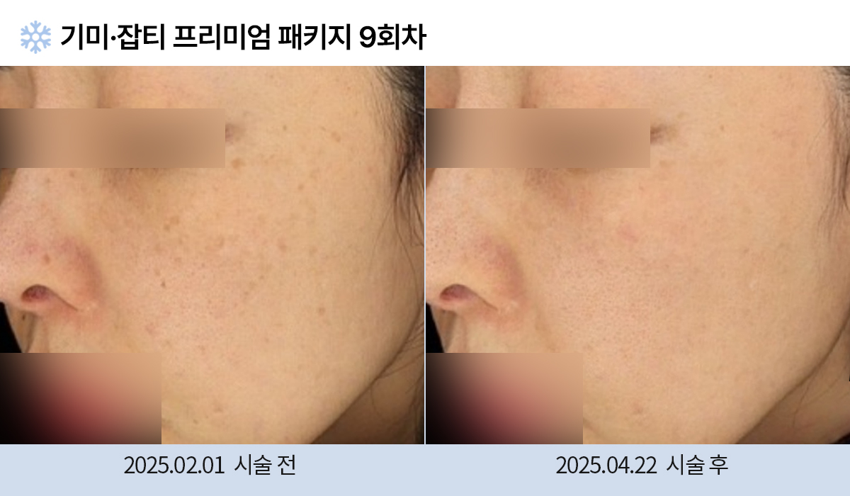 기미/주근깨/잡티 이미지