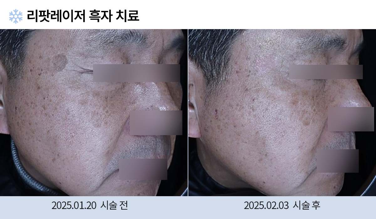흑자/검버섯 이미지