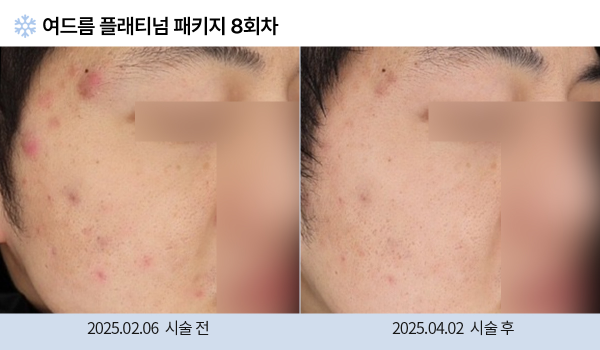 여드름/붉은자국/홍조 이미지