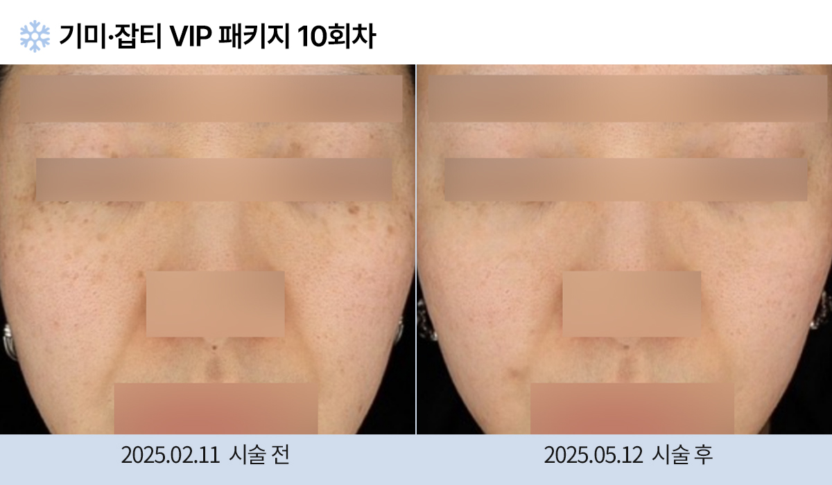 기미/주근깨/잡티 이미지
