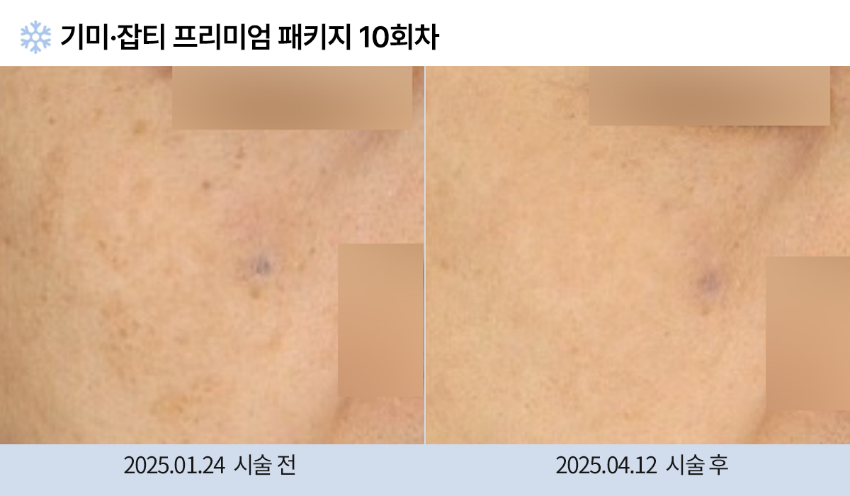 기미/주근깨/잡티 이미지