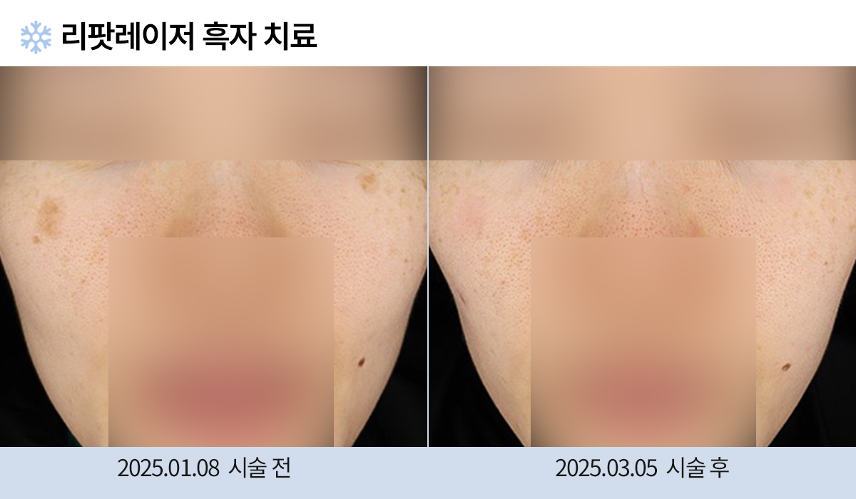 흑자/검버섯 이미지