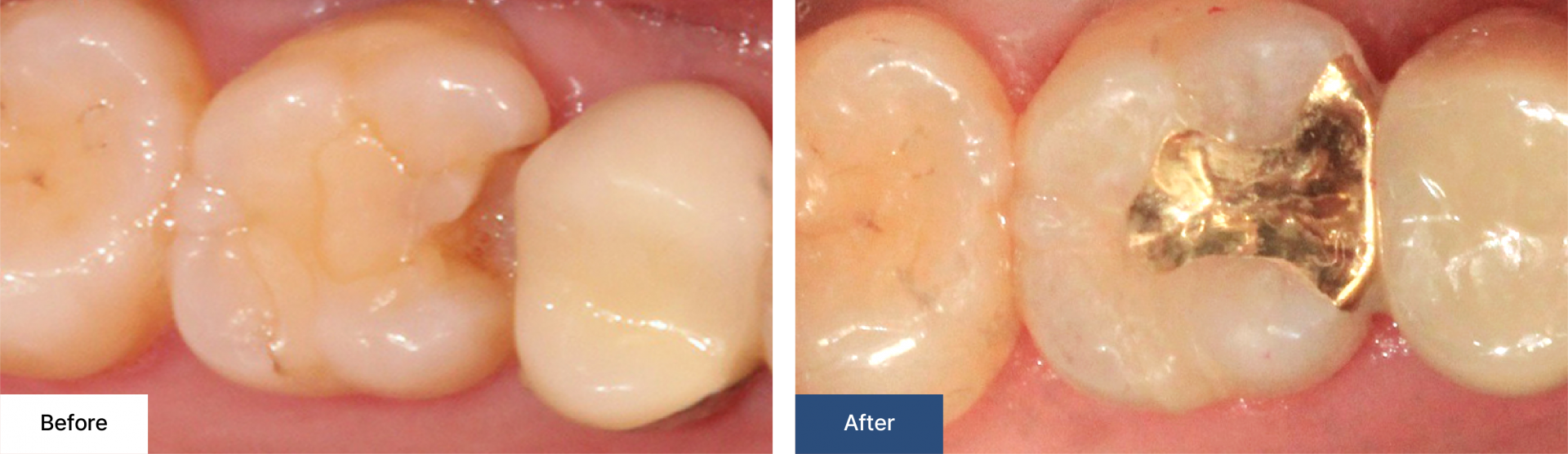 Cavity treatment 3
