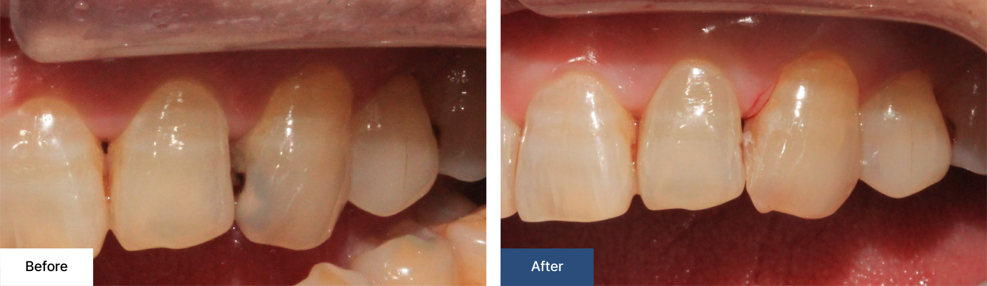 Cavity treatment 1