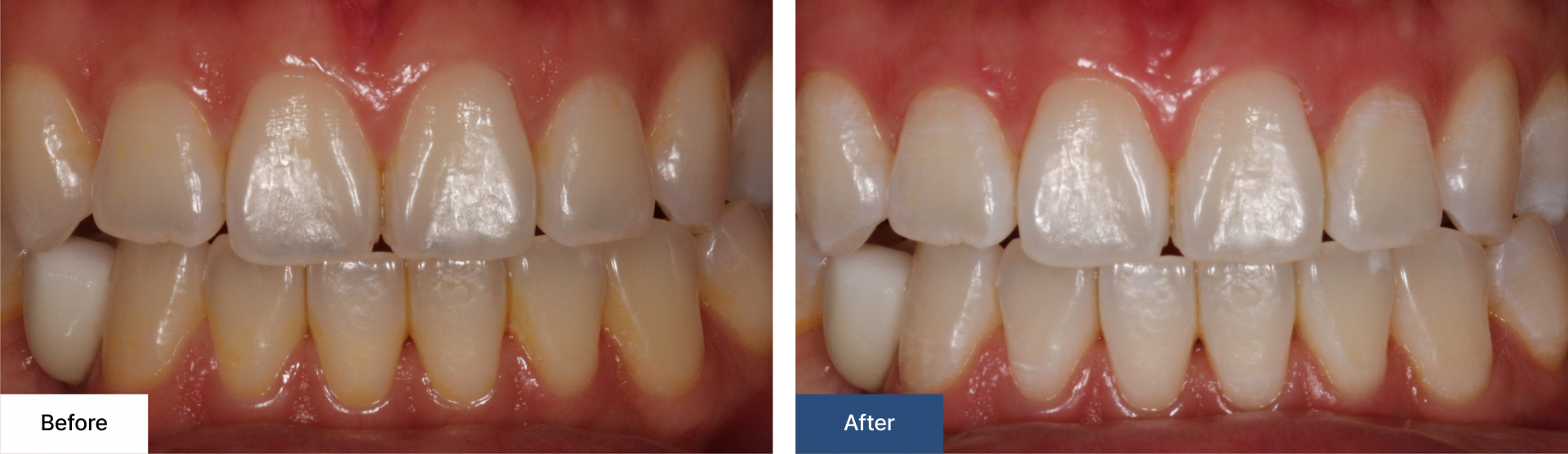Teeth Whitening 2