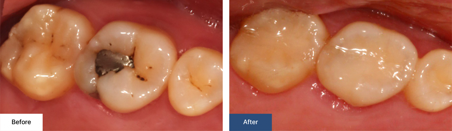 Cavity treatment 2